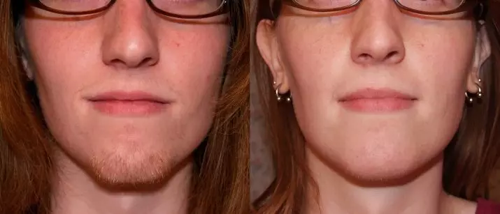 Gesicht Elektro Pocipulation (14 Fotos): Die Entfernung von Schnurrbärte über die Oberlippe und graue Haare bei Frauen, Hautpflege nach Elektroepilation und Bewertungen 13325_14