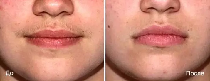 Gesicht Elektro Pocipulation (14 Fotos): Die Entfernung von Schnurrbärte über die Oberlippe und graue Haare bei Frauen, Hautpflege nach Elektroepilation und Bewertungen 13325_4