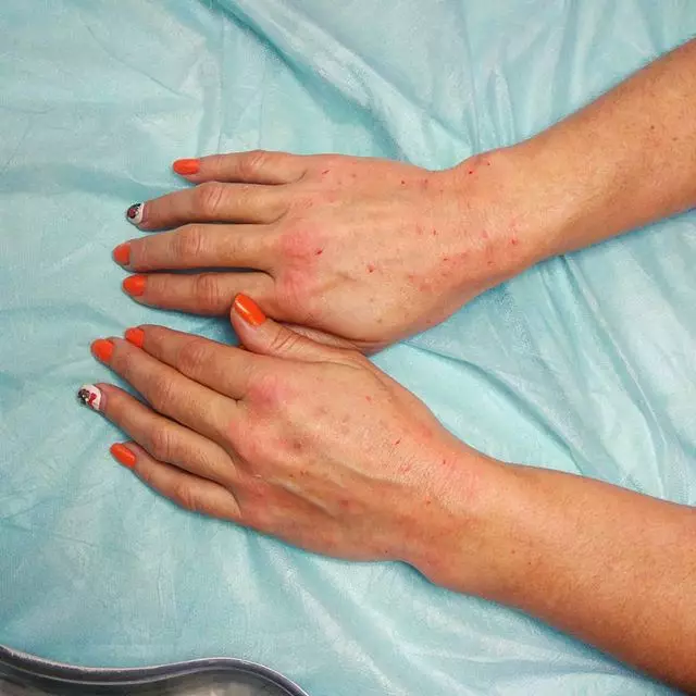 Käsi mesoteraapia (19 pilti): Fraktsioonilise süstimise nahahooldusele, ülevaateid 15775_14