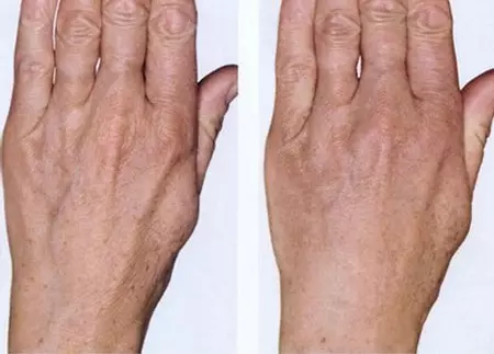 Hand Mesotherapie (19 Pictures): Fractional inspuitings vir Skin Care, resensies 15775_18