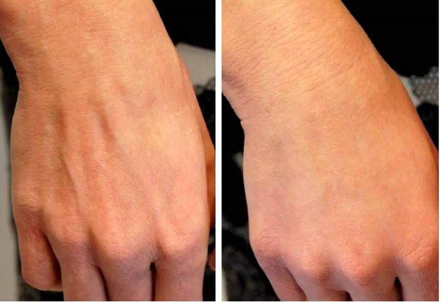 Hand mesotherapie (19 foto's): fractionele injecties voor huidverzorging, reviews 15775_19