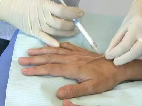Hand Mesotherapie (19 Bilder): Fraktionale Injektionen für Hautpflege, Bewertungen 15775_6