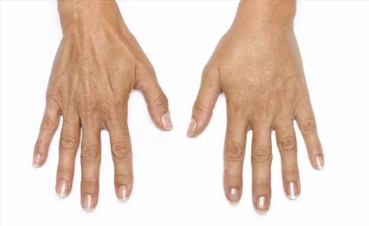 Hand Mesotherapie (19 Biller): Fraktioun Injektiounen fir Hautfleeg, Bewäertungen 15775_9