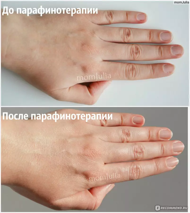 Terapia de parafina fría para as mans (24 fotos): que é e como usar parafina na casa, comentarios 15781_22