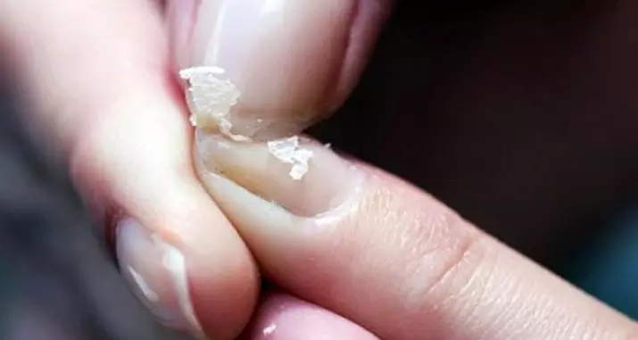 釘は敷設（30枚の写真）：親指を剥がし、皮膚の手の上に剥がれます。なぜ爪と女性が落ち着いているのですか？ 15810_12