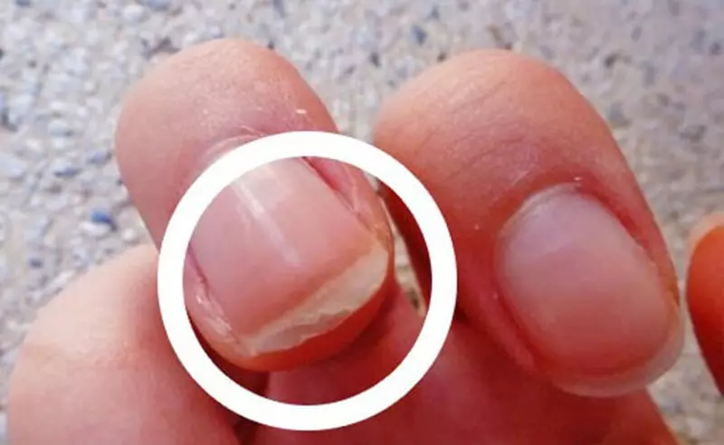 Nails suna kwance (hotuna 30): sanannun peeling a yatsa da a hannun fata. Me yasa kusoshi da mata suka sauka? 15810_15