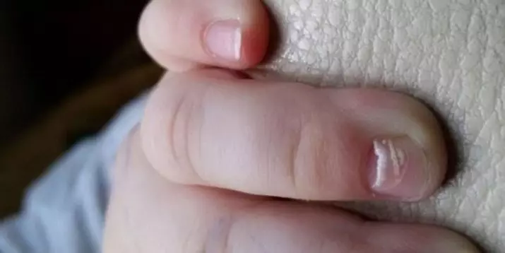 釘は敷設（30枚の写真）：親指を剥がし、皮膚の手の上に剥がれます。なぜ爪と女性が落ち着いているのですか？ 15810_16