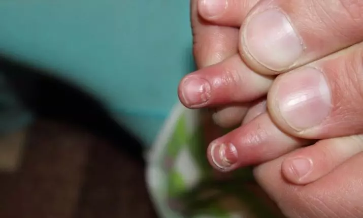 Unghiile se îndreaptă (30 de fotografii): cauzele de peeling pe degetul mare și pe mâinile pielii. De ce se stabilesc unghiile și femeile? 15810_22