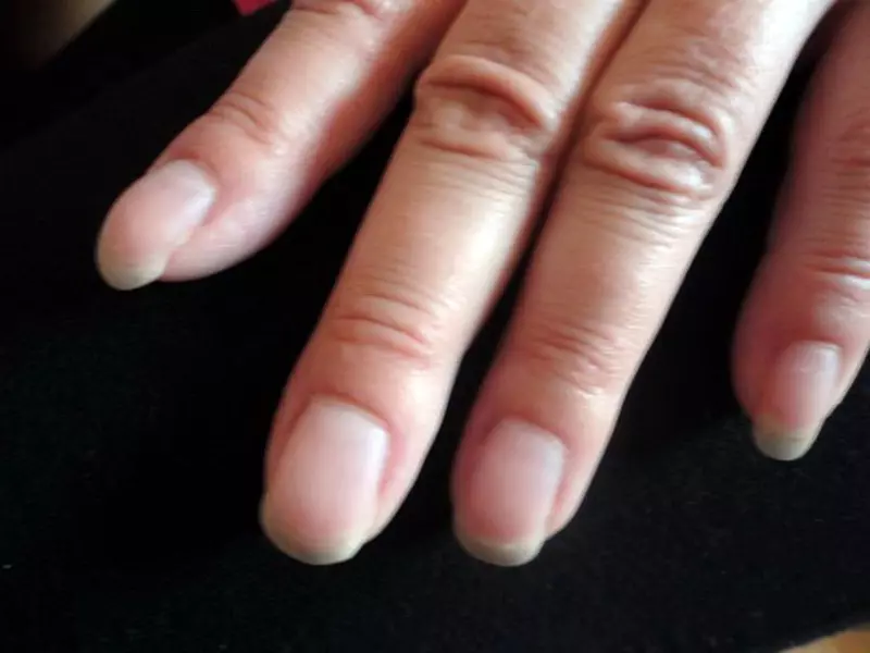 Выросли пальцы на руке. Широкие ногти.