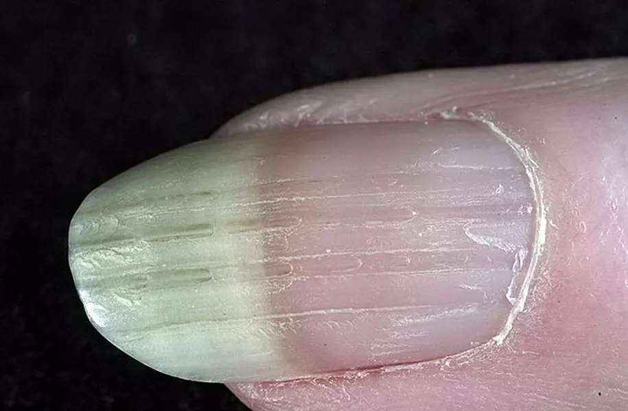 Hoe snel groeien nagels? Hoeveel nagels groeien voor een maand en op welke snelheid? Oorzaken van nagelgroei, omhoog en golven bij de hand? 15811_17