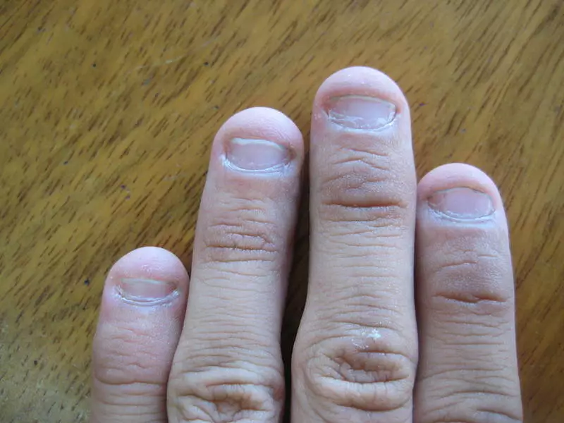 Hoe snel groeien nagels? Hoeveel nagels groeien voor een maand en op welke snelheid? Oorzaken van nagelgroei, omhoog en golven bij de hand? 15811_25
