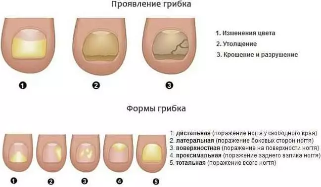 Naglar på benen växer upp (23 bilder): hur man fixar konkava naglar i ett barn och vuxen? 15824_11