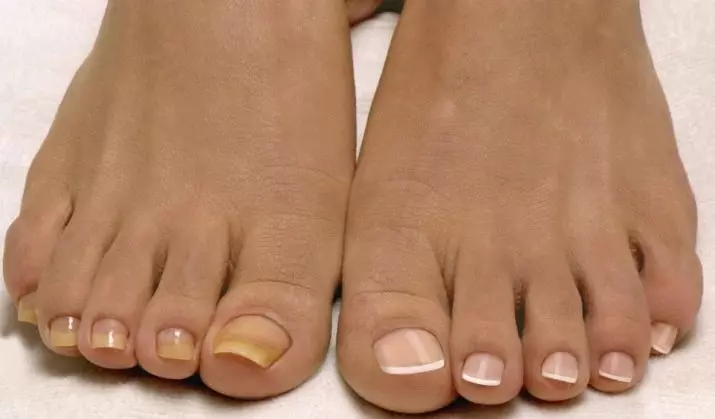 Ноктите на нозете растат (23 фотографии): Како да се поправат конкавни нокти во дете и возрасни? 15824_20
