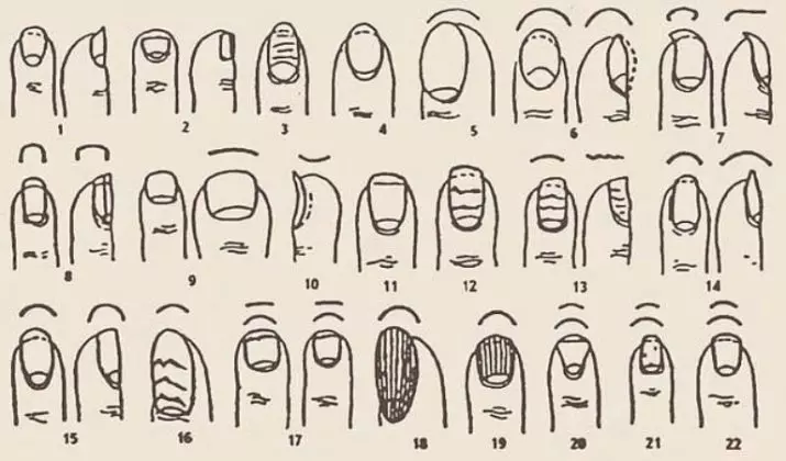 Naglar på benen växer upp (23 bilder): hur man fixar konkava naglar i ett barn och vuxen? 15824_8