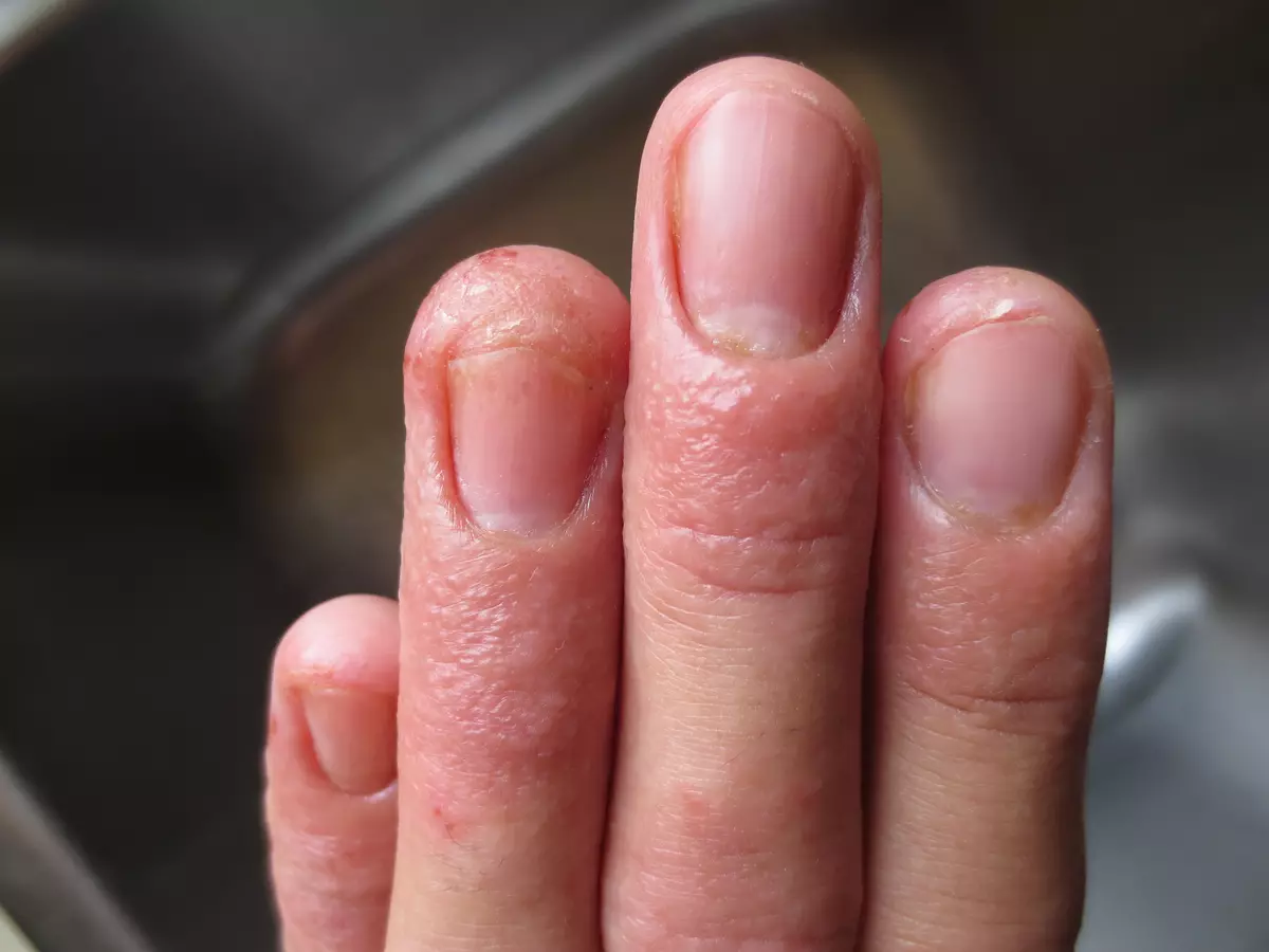 Dị ứng với Gel-Varnish (32 ảnh): Triệu chứng và nguyên nhân xuất hiện, danh sách các đánh bóng móng tay không gây dị ứng. Những gì bìa gây dị ứng và làm thế nào để đối xử với nó? 15825_11