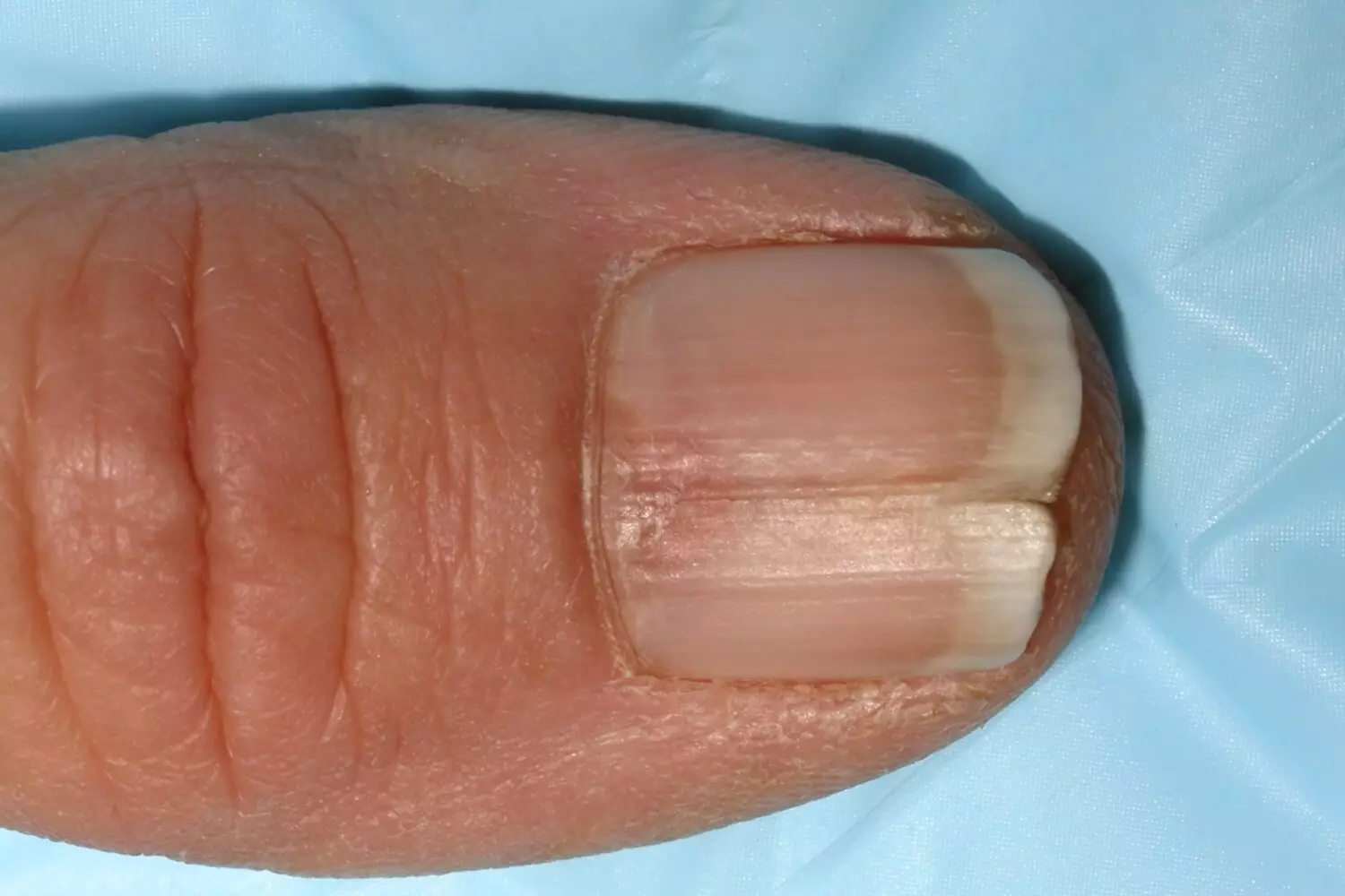 Алергія на гель-лак (32 фото): симптоми і причини появи, список гіпоалергенних лаків для нігтів. Які покриття викликають алергію і як її лікувати? 15825_12