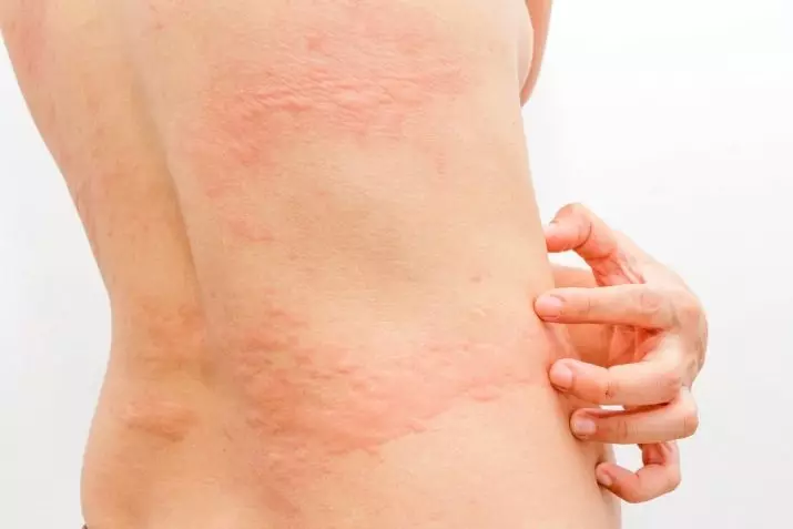 Allergie à gel-vernis (32 photos): Symptômes et causes d'apparence, Liste des vernis à ongles hypoallergéniques. Quels couvercons causent des allergies et comment le traiter? 15825_17