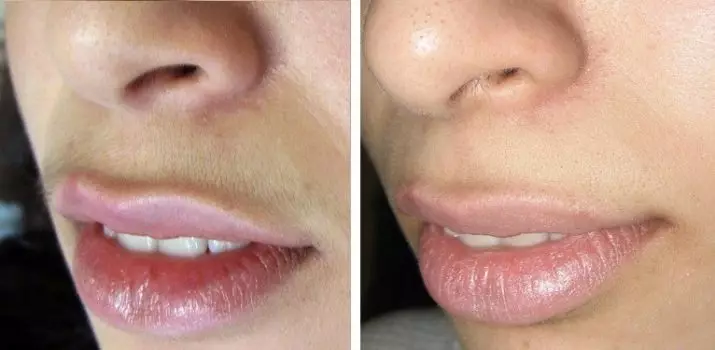 Fotoepilacija gornje usne (12 fotografija): Što je fotoepilacija brkova kod žena? Koliko je bljeskova potrebna za epilaciju? 15969_4