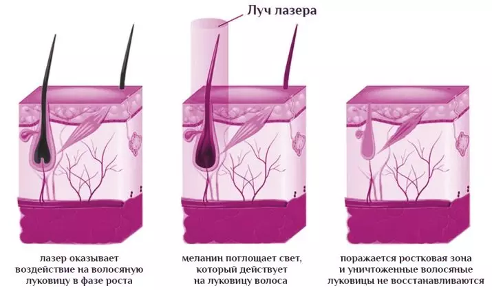 Гулайли лазери минтақаи Бикини минтақа (23 акс): Ҷамъоварии мӯи умумӣ ва иловагӣ, хориҷ кардани мӯи классикӣ дар соҳаи бикини, пас аз баррасиҳо 15982_3