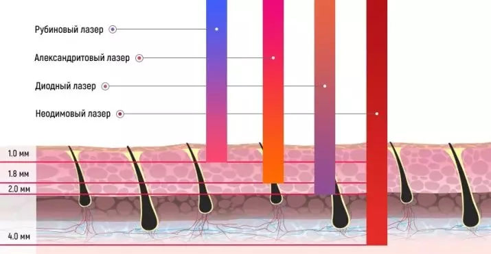 Laser Epalation ya Eneo la Bikini (Picha 23): Jumla na Bikini ya ziada, kuondolewa kwa nywele za kawaida katika uwanja wa bikini, baada na kitaalam 15982_4