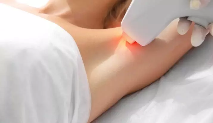 Laser Epilation Bikini Dalam (18 Foto): Bagaimana Epilasi Zona Bikini dengan Laser? Persiapan untuk prosedur. Apa yang termasuk? Ulasan setelah prosedur 15995_6