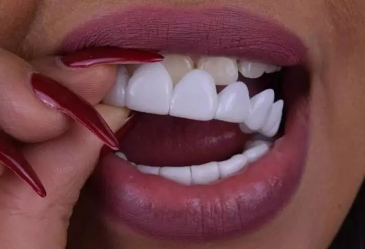 Como branquear os dentes em casa? 34 Foto Os melhores meios de branqueamento com suas próprias mãos. Como fazer rapidamente os dentes brancos em casa? 16128_34
