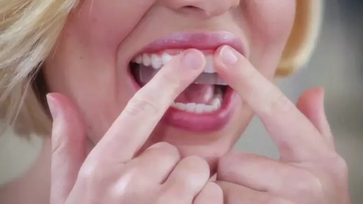Balināšanas sloksnes zobiem: labākās balināšanas plāksnes. Kā izmantot? Kaitīga vai palīdzība? Reitings un kā izmantot atsauksmes 16130_40