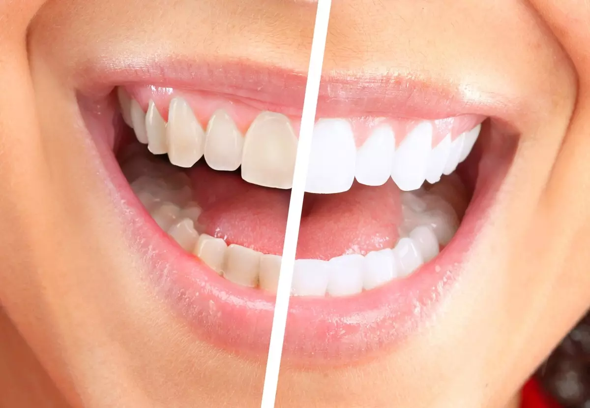 Да ли је могуће четкати соде зубе? Предности и повреде чишћења хране хране. Колико често га и правилно примените за избјељивање? Да ли је штетно да их очистите сваки дан? 16147_16