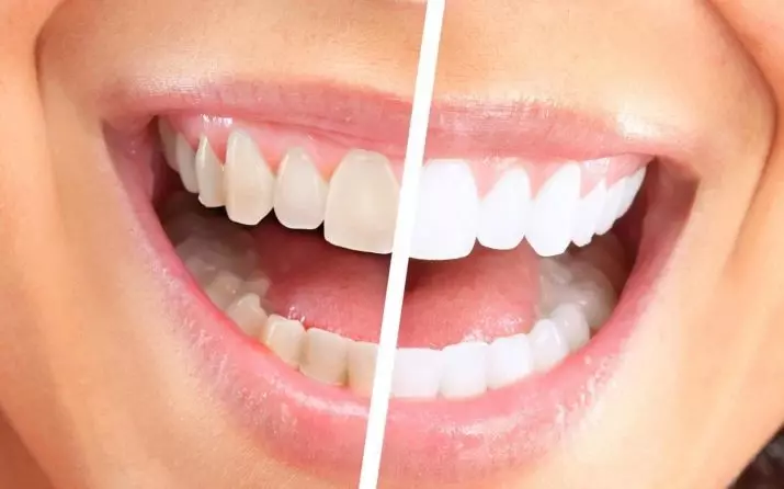 Olovke za izbjeljivanje zubi: izbjeljivanje zubi olovke, globalne bijele i druge. Kako koristiti zubne ručke za uklanjanje plaketa? 16150_29