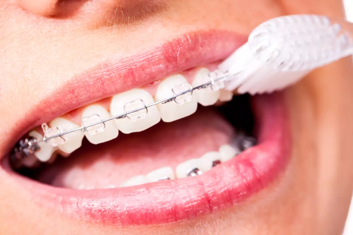 كيف لفرشاة الأسنان مع الأقواس؟ اختيار معجون الأسنان. كيفية رعاية الأسنان الخاصة بك مع نظام قوس؟ كم مرة يمكنك فرشاة أسنانك؟ 16155_10