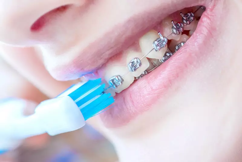 كيف لفرشاة الأسنان مع الأقواس؟ اختيار معجون الأسنان. كيفية رعاية الأسنان الخاصة بك مع نظام قوس؟ كم مرة يمكنك فرشاة أسنانك؟ 16155_11