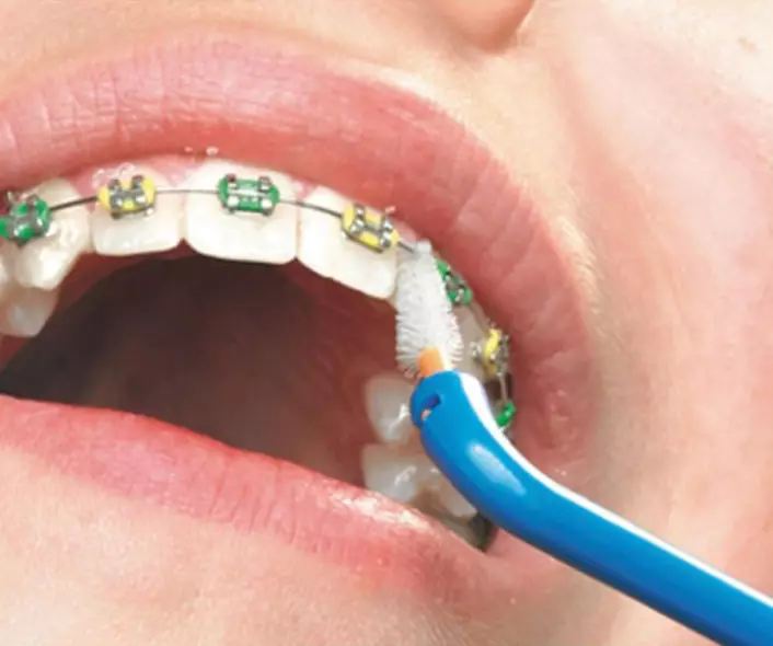 كيف لفرشاة الأسنان مع الأقواس؟ اختيار معجون الأسنان. كيفية رعاية الأسنان الخاصة بك مع نظام قوس؟ كم مرة يمكنك فرشاة أسنانك؟ 16155_15