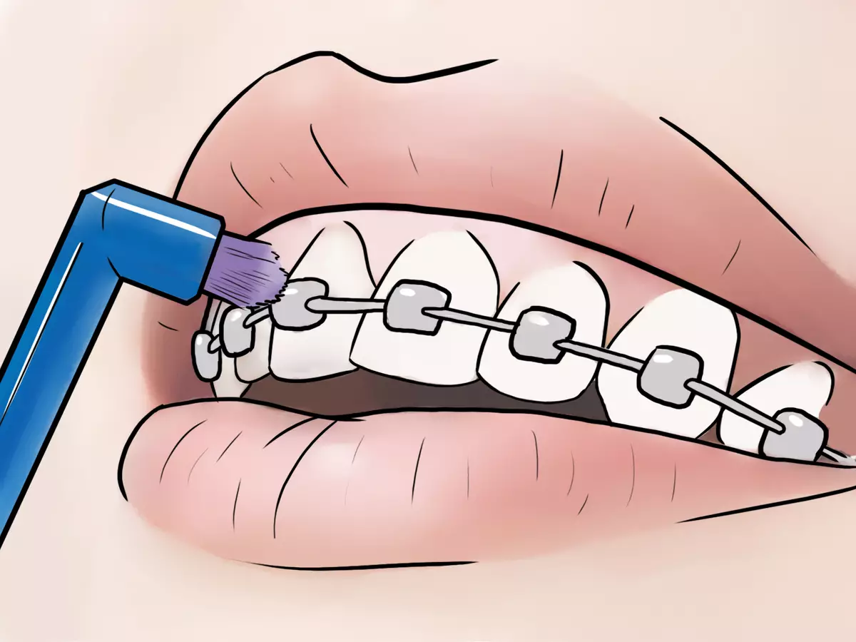 كيف لفرشاة الأسنان مع الأقواس؟ اختيار معجون الأسنان. كيفية رعاية الأسنان الخاصة بك مع نظام قوس؟ كم مرة يمكنك فرشاة أسنانك؟ 16155_17