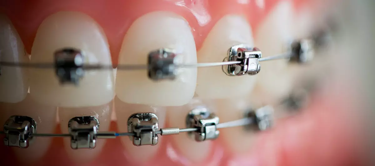 كيف لفرشاة الأسنان مع الأقواس؟ اختيار معجون الأسنان. كيفية رعاية الأسنان الخاصة بك مع نظام قوس؟ كم مرة يمكنك فرشاة أسنانك؟ 16155_2