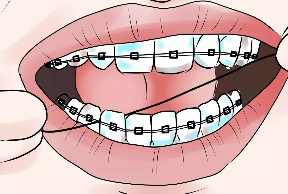 કૌંસ સાથે દાંત સાફ કેવી રીતે? ટૂથપેસ્ટની પસંદગી. કૌંસ સિસ્ટમ સાથે તમારા દાંતની કાળજી કેવી રીતે કરવી? તમે તમારા દાંત કેટલી વાર બ્રશ કરી શકો છો? 16155_21