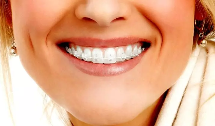 كيف لفرشاة الأسنان مع الأقواس؟ اختيار معجون الأسنان. كيفية رعاية الأسنان الخاصة بك مع نظام قوس؟ كم مرة يمكنك فرشاة أسنانك؟ 16155_33