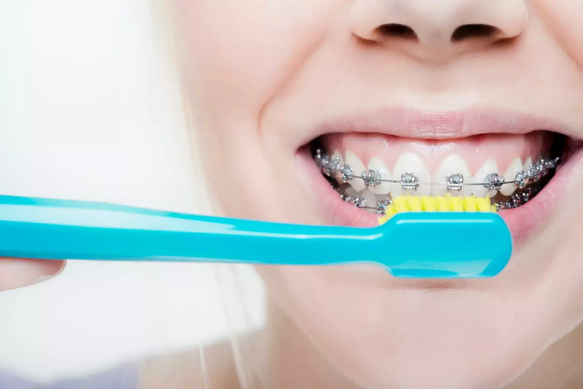 كيف لفرشاة الأسنان مع الأقواس؟ اختيار معجون الأسنان. كيفية رعاية الأسنان الخاصة بك مع نظام قوس؟ كم مرة يمكنك فرشاة أسنانك؟ 16155_5