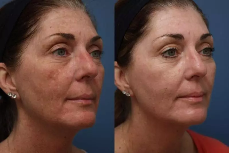 Peeling Jessner (28 fotos): el que és, l'efecte després de tractaments facials de Hollywood, contraindicacions, la composició d'aplicacions, opinions 16396_21