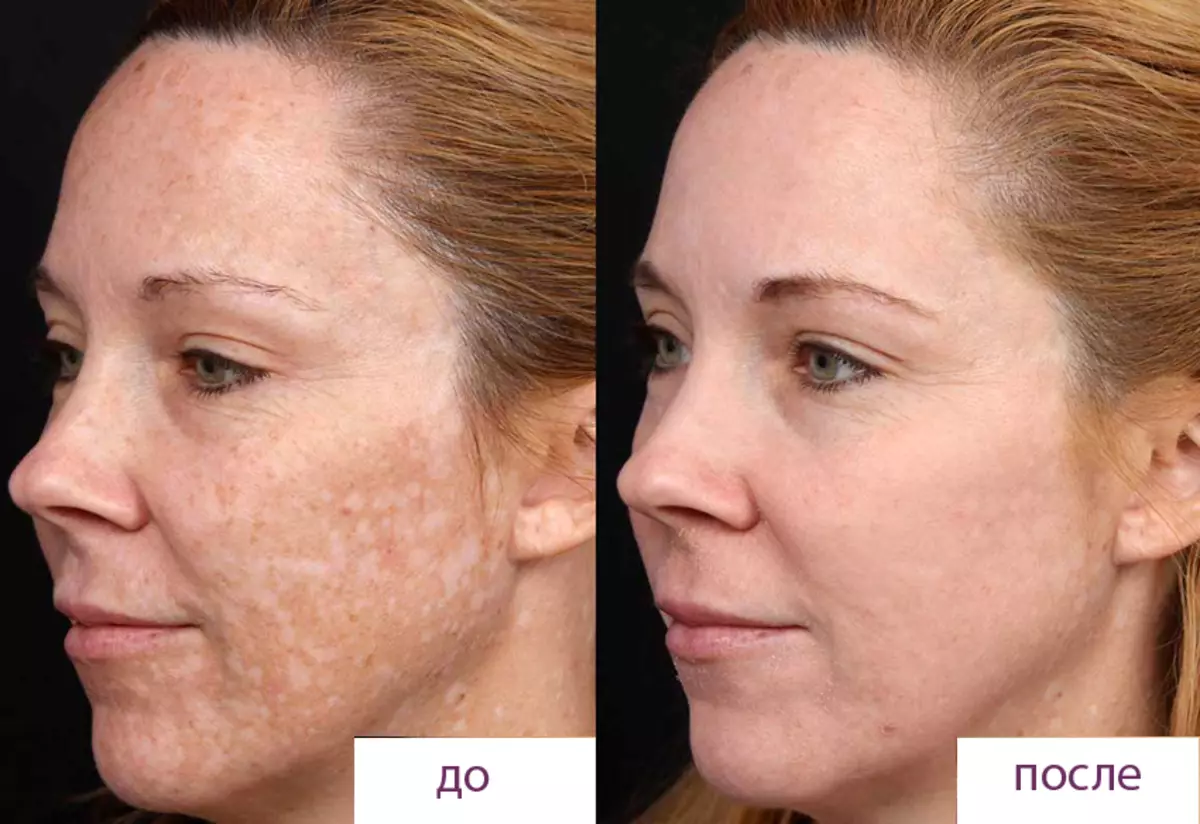 Peeling Jessner (28 fotos): el que és, l'efecte després de tractaments facials de Hollywood, contraindicacions, la composició d'aplicacions, opinions 16396_22