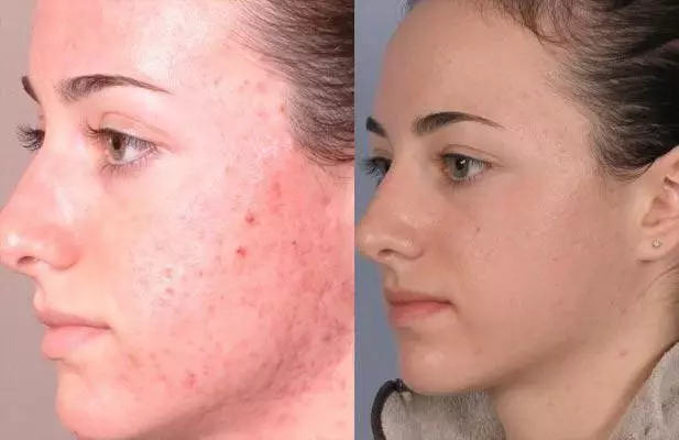 What is the difference in peeling from scrub? What is the difference and what is better, the difference between the procedures for the face from each other 16410_21
