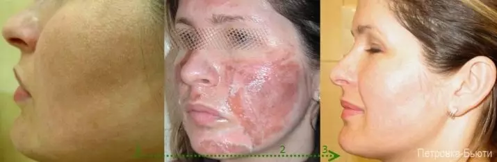 Glikolio lupimas (46 nuotraukos): paviršiaus procedūra su rūgštimi už veidą namuose, kas tai yra, atsiliepimai 16413_13