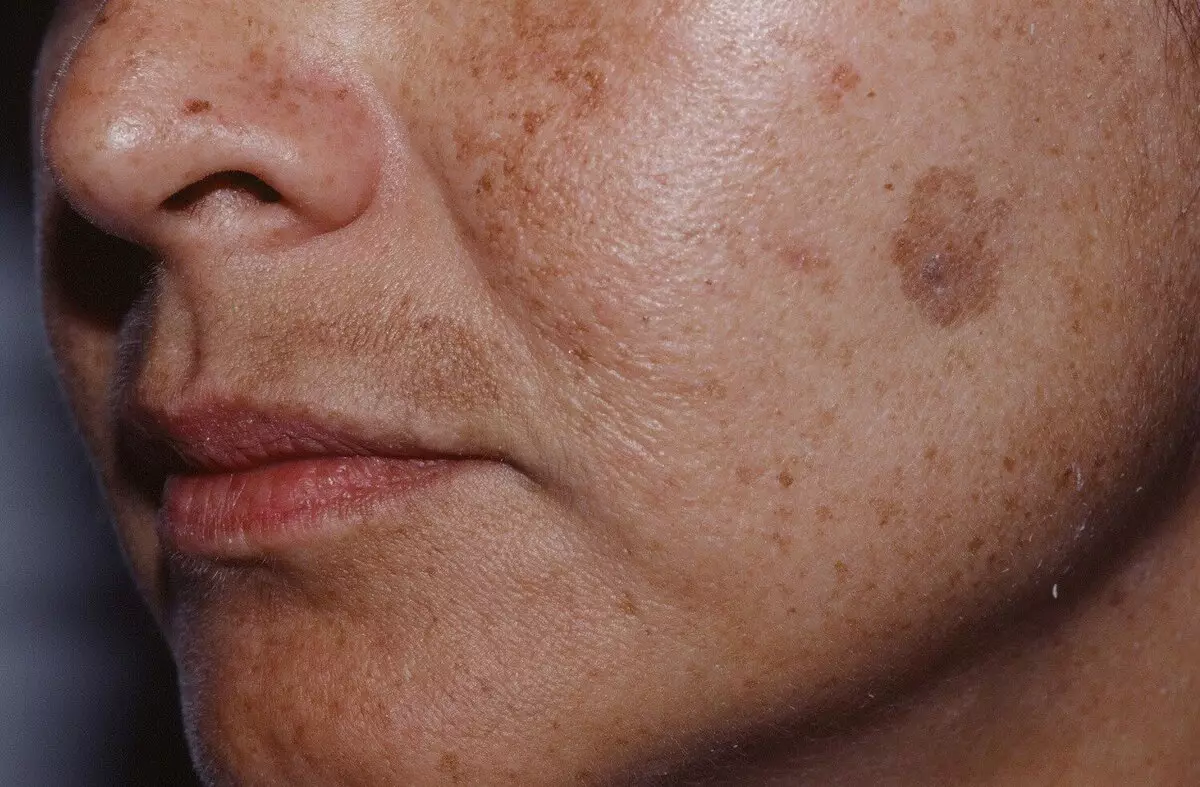 Glykolové peeling (46 fotografií): povrchový postup s kyselinou pre tvár doma, čo to je, recenzie 16413_15