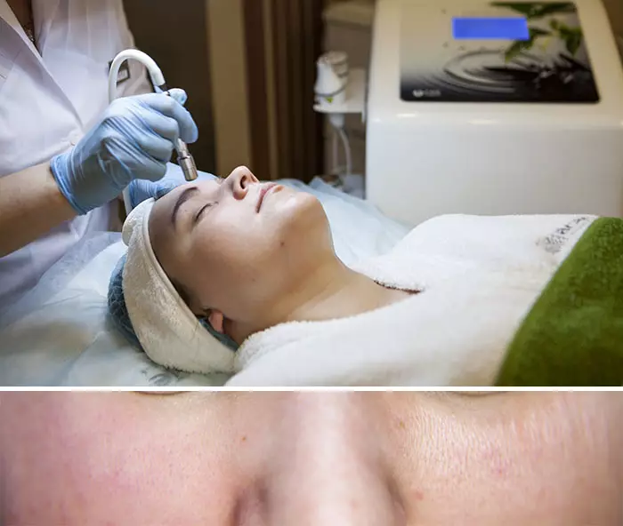 Diamond Peeling (44 fotos): que é, limpeza facial de baleiro de diamante, testemuño e contraindicacións, comentarios 16419_36