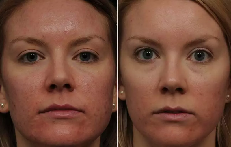 BiRevitalização (80 fotos): o que é efecto, un procedemento con ácido hialurónico para a cara, as revisións 16444_12
