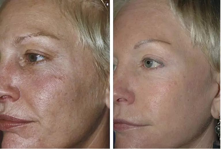BiRevitalização (80 fotos): o que é efecto, un procedemento con ácido hialurónico para a cara, as revisións 16444_13