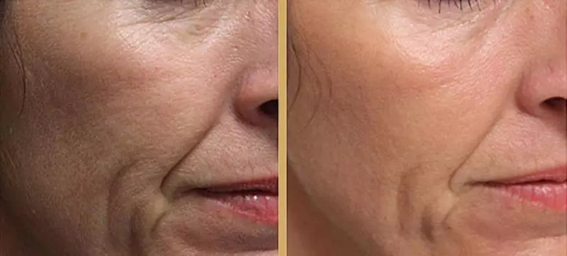 BiRevitalização (80 fotos): o que é efecto, un procedemento con ácido hialurónico para a cara, as revisións 16444_16