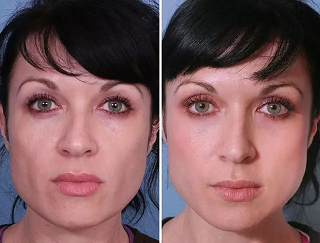 BiRevitalização (80 fotos): o que é efecto, un procedemento con ácido hialurónico para a cara, as revisións 16444_17