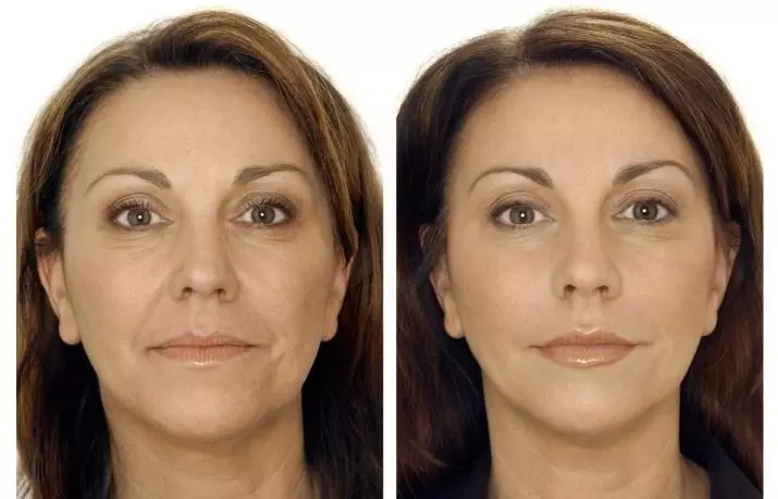 BiRevitalização (80 fotos): o que é efecto, un procedemento con ácido hialurónico para a cara, as revisións 16444_43