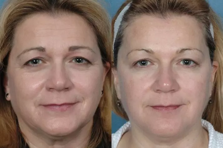 BiRevitalização (80 fotos): o que é efecto, un procedemento con ácido hialurónico para a cara, as revisións 16444_47