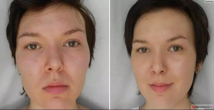 BiRevitalização (80 fotos): o que é efecto, un procedemento con ácido hialurónico para a cara, as revisións 16444_80